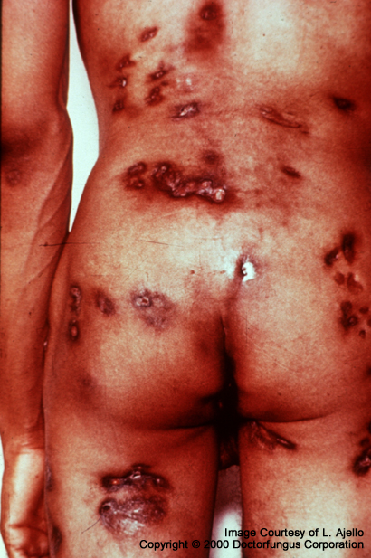 cocci